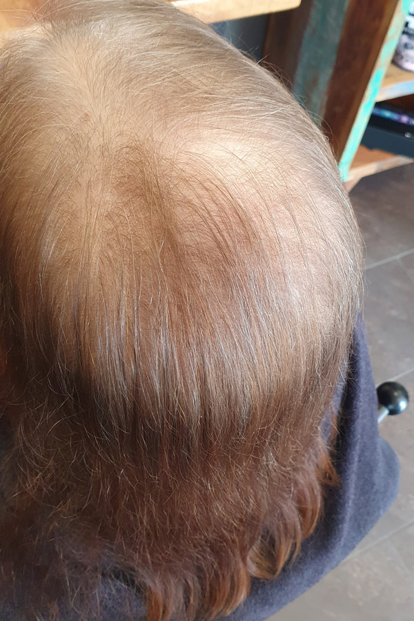 Vorher-Foto Kunden mit Haarausfall