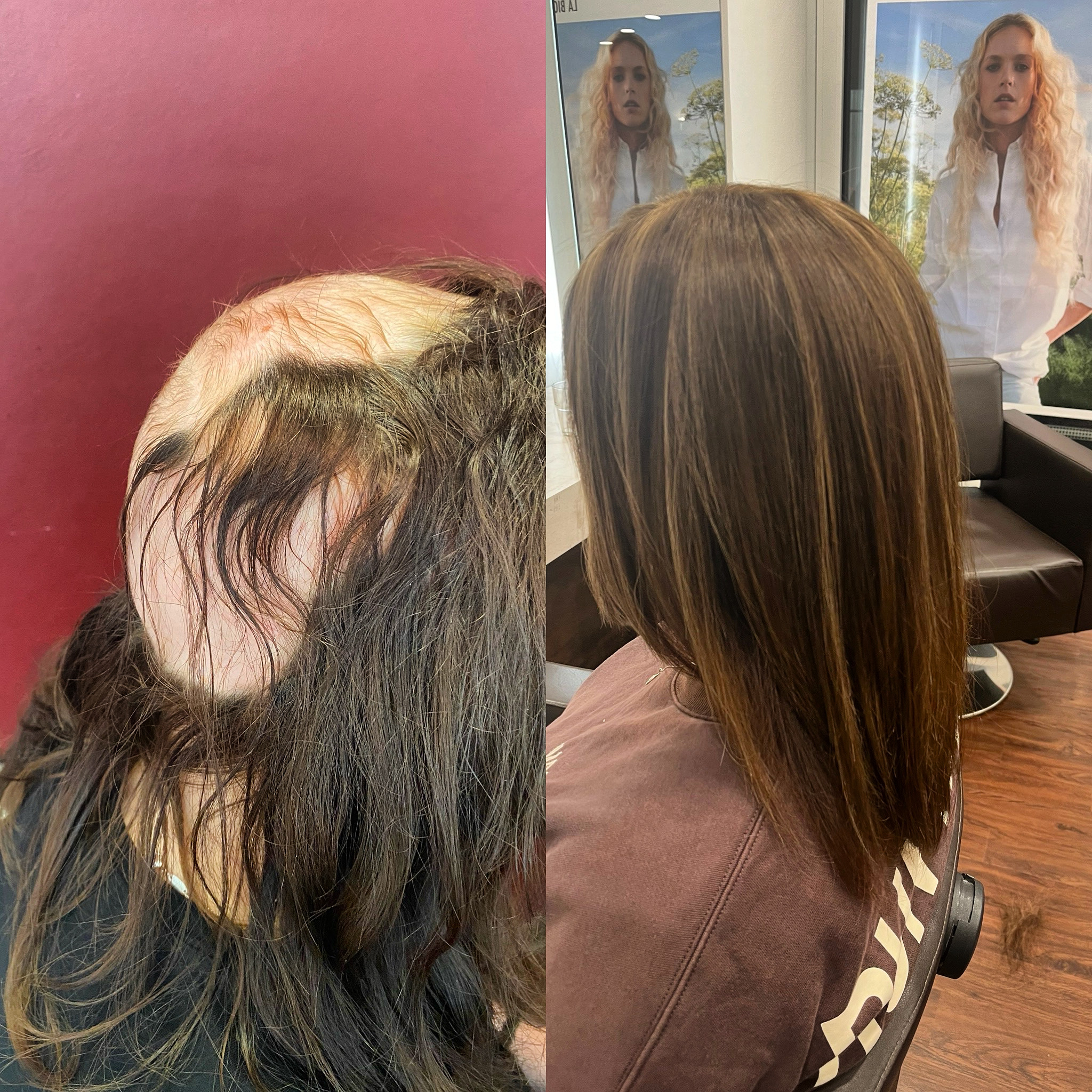 Vorher-Nachher von Kundin mit kreisrundem Haarausfall