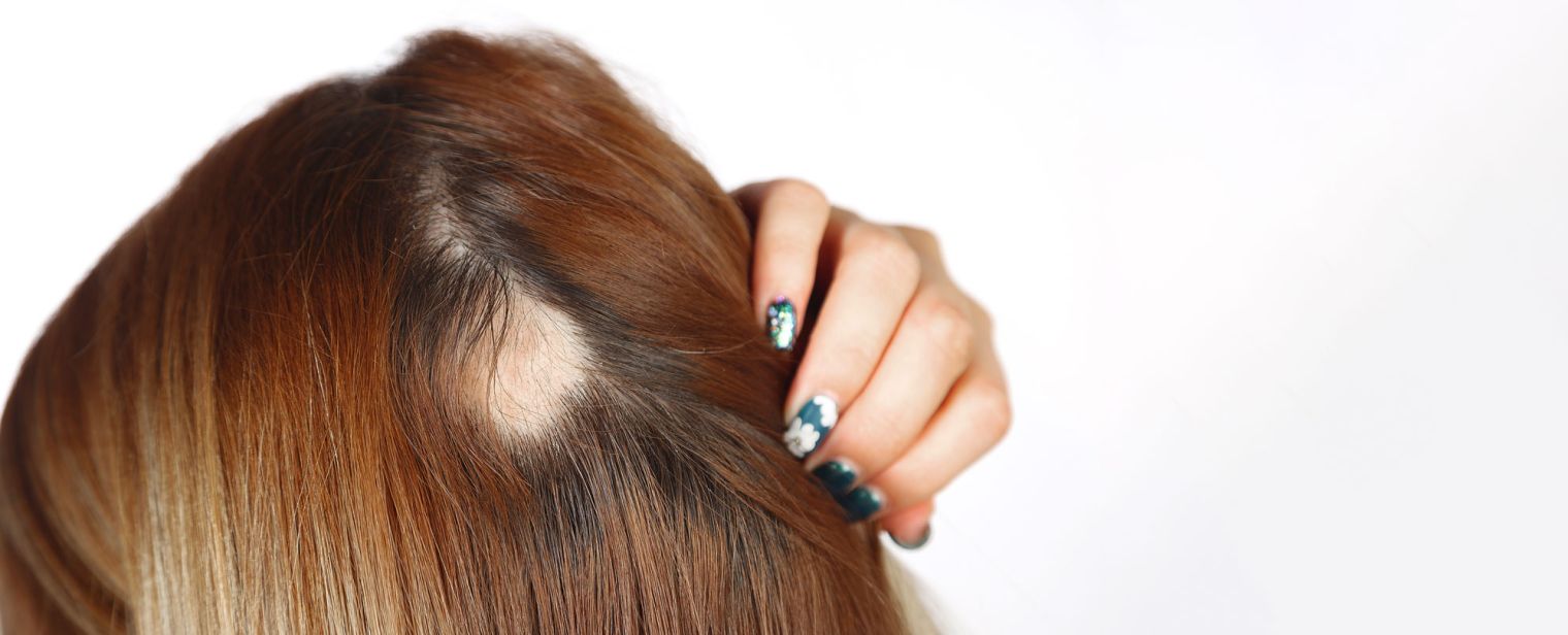 Erkennbarer kreisrunder Haarausfall