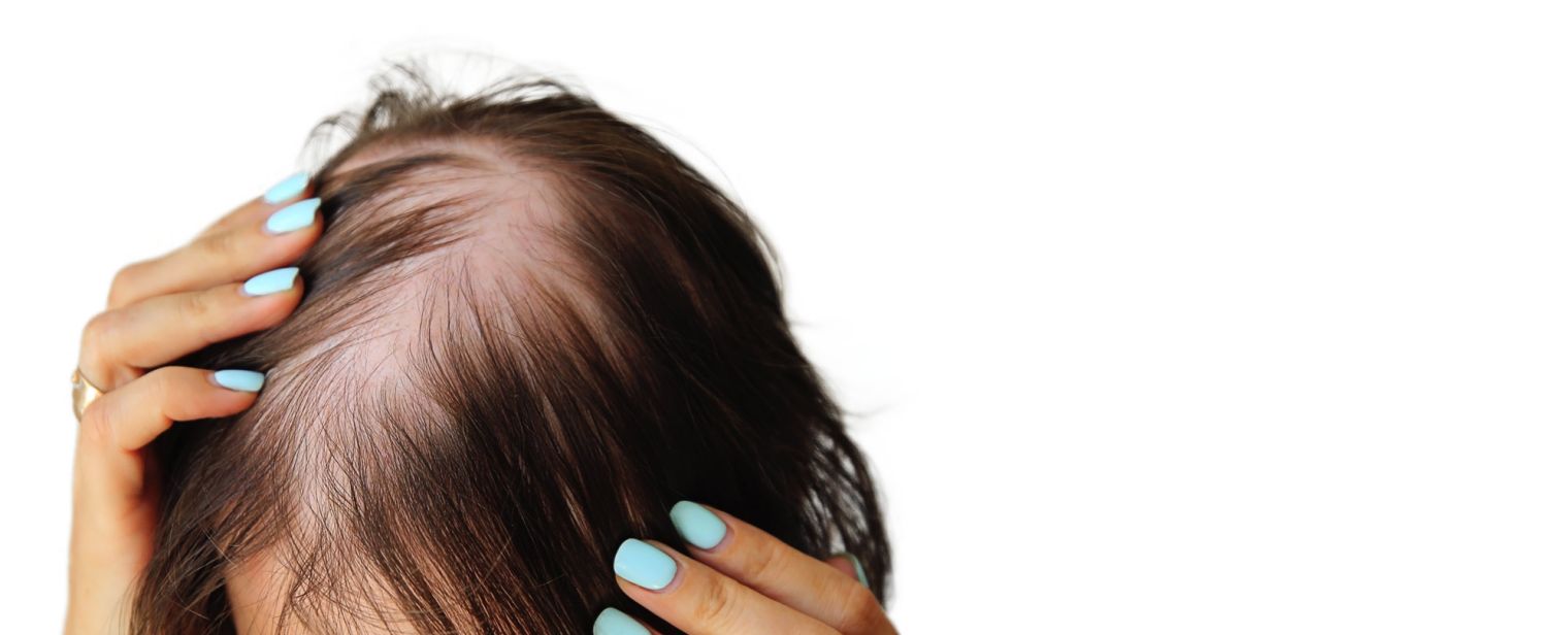 Frau mit schwerem Haarausfall, die sich eine Lösung wünscht