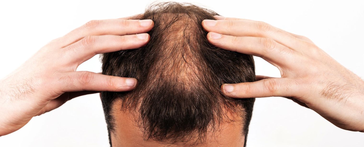Mann der unter starkem Haarausfall leidet