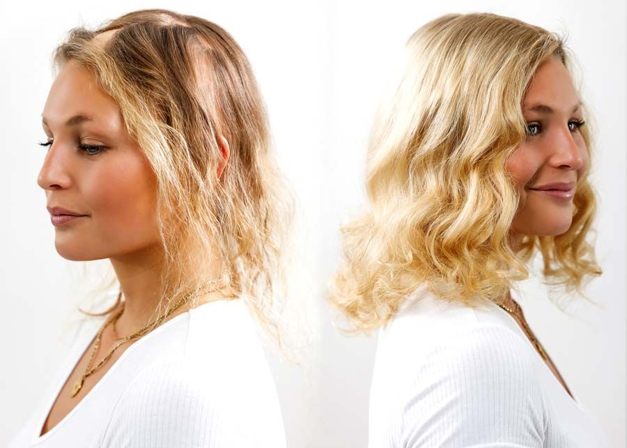 Frau mit kreisrundem Haarausfall und mit Tritec