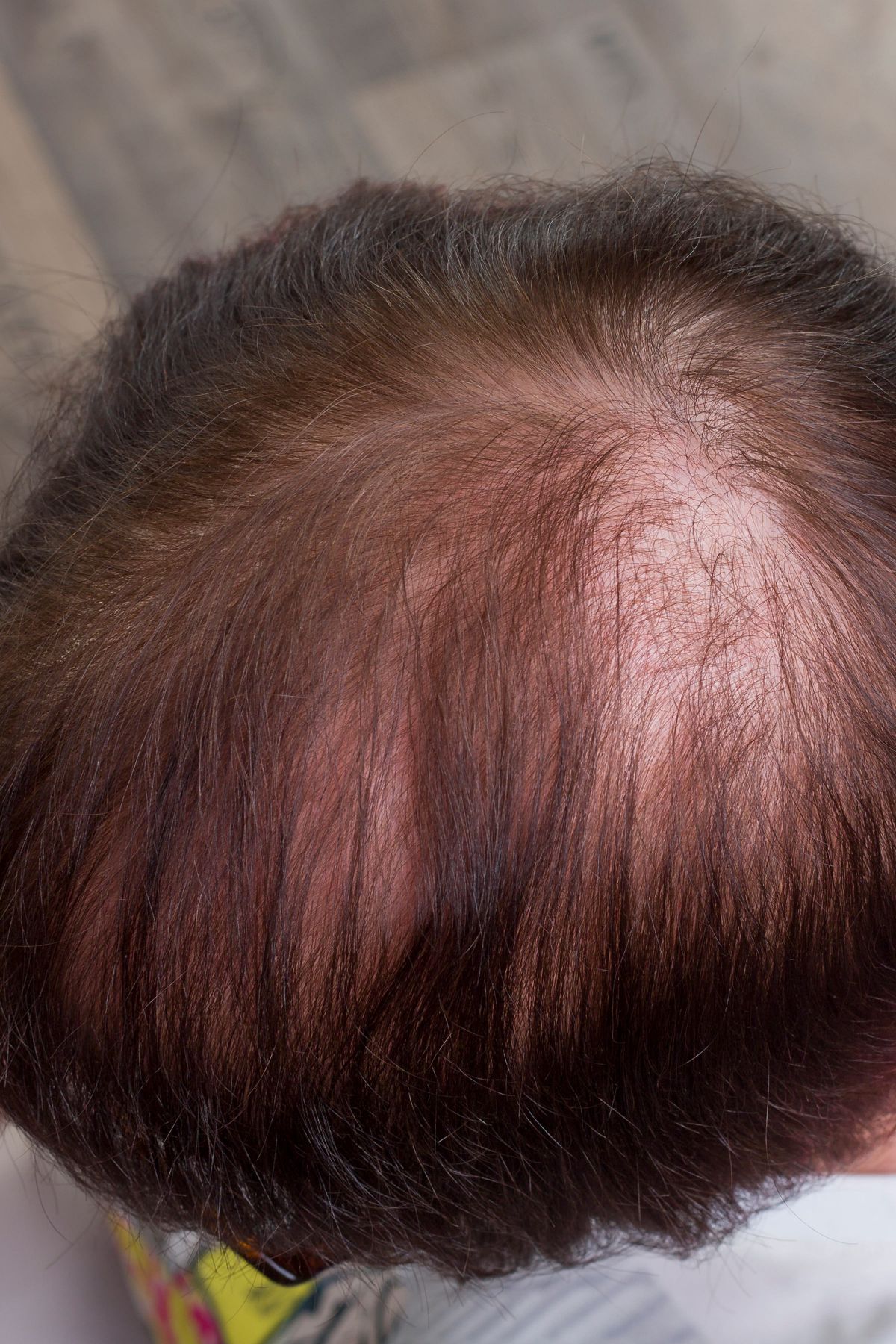 Gegen Haarausfall Frauen Gegen Haarausfall Frauen